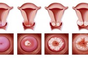 初期宫颈癌的五大征兆