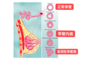 浸润性导管癌患者的交流群平台，与癌症斗争