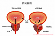 前列腺癌如何预防,前列腺癌怎么预防？