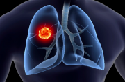 肺癌群交流群资讯,小细胞肺癌生存期多久？