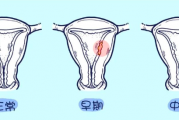子宫内膜癌群答疑,子宫内膜癌的六个信号