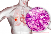2024肺癌病友交流群答疑：肺癌扩散淋巴甲状腺可以化疗吗？