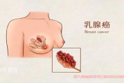  三阴和三阳乳腺癌哪个凶险,加入全国乳腺癌病友群