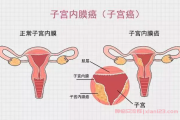 2024子宫癌交流群，抗癌经验交流患者社群