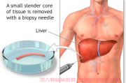 肝癌病友交流群，肝穿刺检查确诊肝癌的意义
