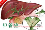 胆管癌扩散转移症状,胆管癌家属交流群讨论