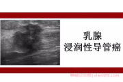 左乳浸润性导管癌2级保乳手术后的治疗方案