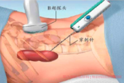 肿瘤穿刺活检是什么意思,为什么需要穿刺活检?