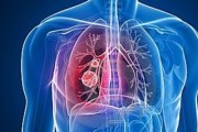 肺部位上长瘤一定是癌症吗？