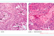 肺癌中鳞癌和腺癌有什么区别？肺癌群答疑