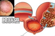 引起膀胱癌的主要原因是什么？该如何预防