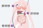 乳腺癌抗癌群建群了,乳腺癌术后会复发转移吗？