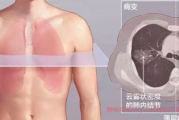 发现肺部混杂磨玻璃结节8.8mm继续随访还是直接手术？