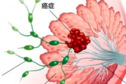 抗击乳腺癌战友群解答:乳腺癌淋巴转移并伴有皮肤及后背溃烂怎么治疗
