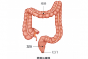 肠癌病友群答疑,直肠癌与结肠癌有何区别