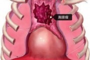 胸腺瘤分型哪些，该如何诊断和治疗？