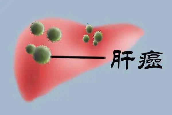 肝癌微信群