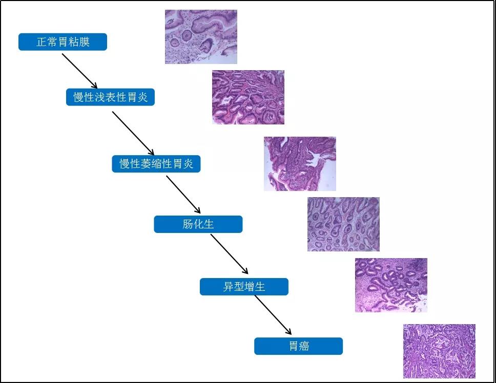 胃癌发展演变过程