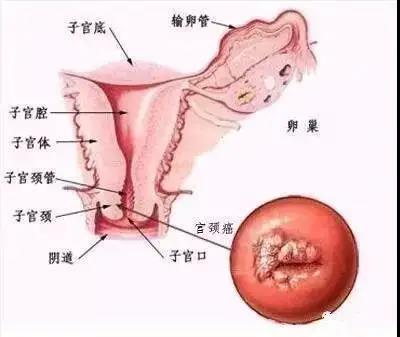 宫颈癌是什么