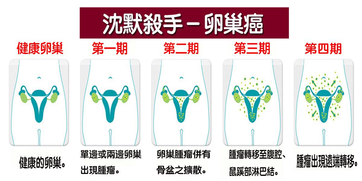 卵巢癌分期