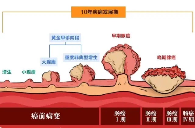 肠癌癌前病变 肠癌癌前病变