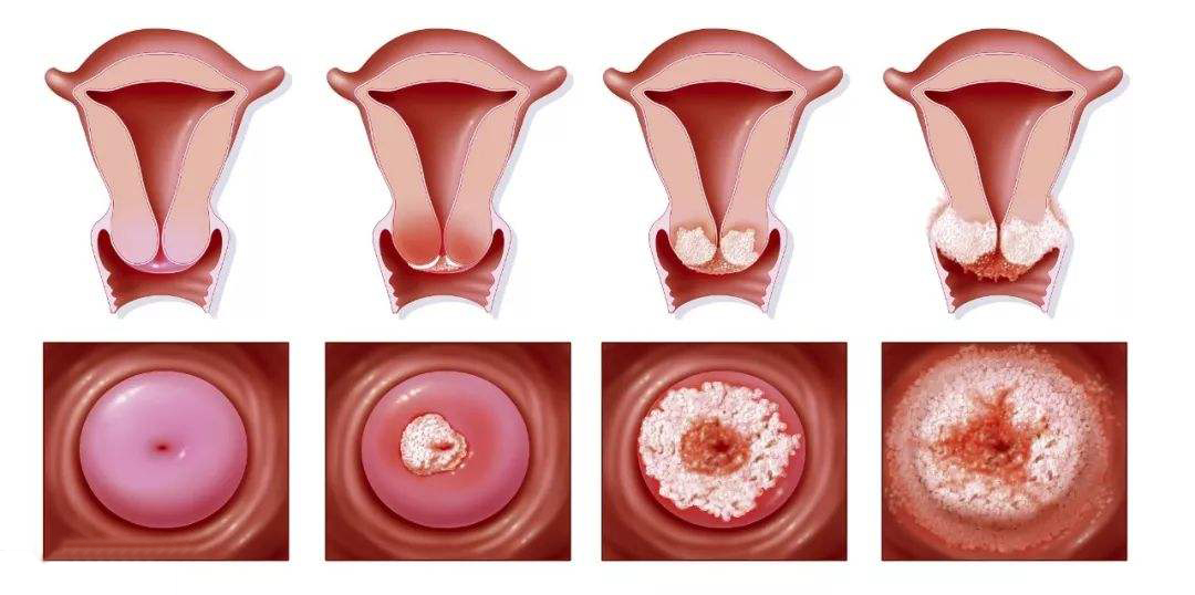 宫颈癌早期症状