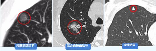 肺结节大小