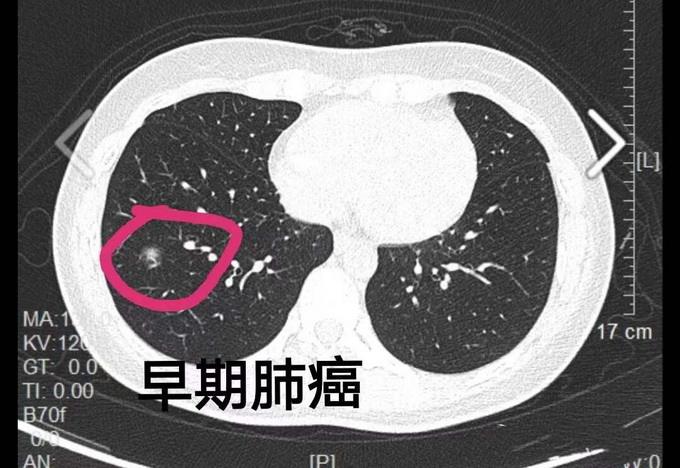早期肺癌不手术
