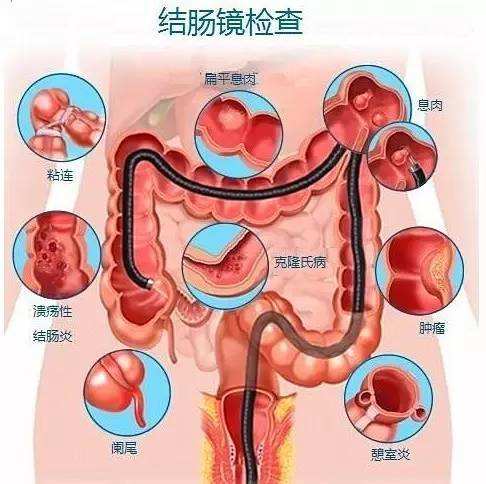 肠癌结肠镜