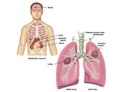 肺癌转移症状