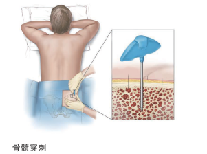 淋巴瘤穿刺