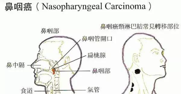 鼻咽癌患者营养不良怎么办