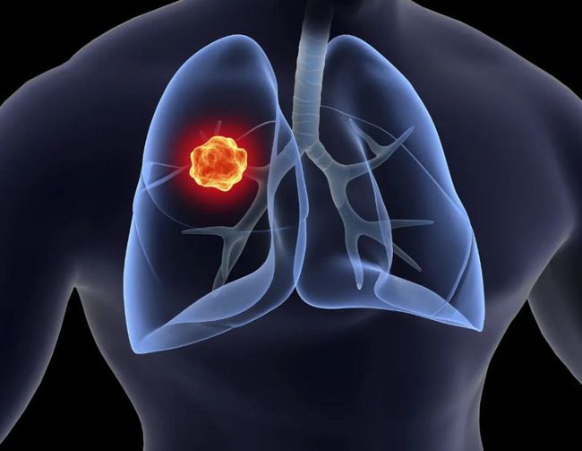 小细胞肺癌治疗有哪些