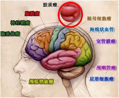 脑部肿瘤有哪些