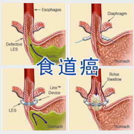 食管癌,食管癌预防,食管癌病因,食管癌分期