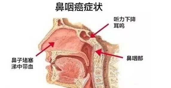 鼻咽癌治疗预后