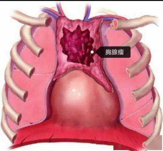 胸腺瘤诊断治疗