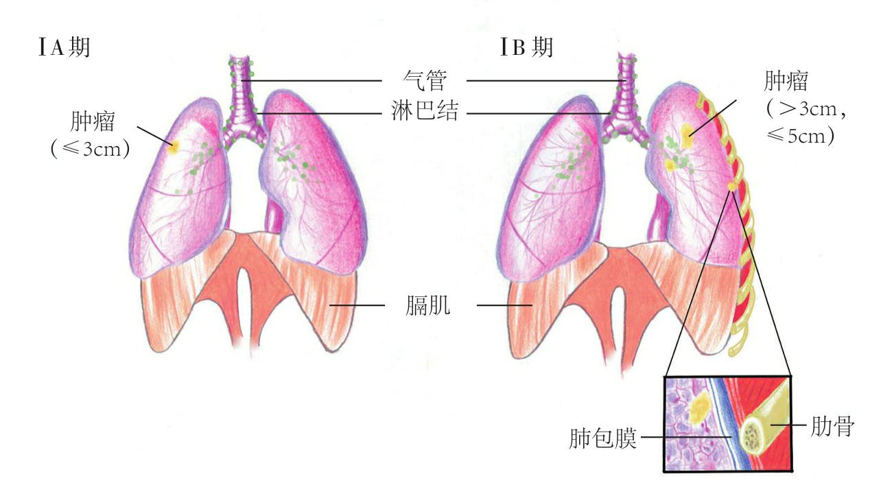 肺癌的分期
