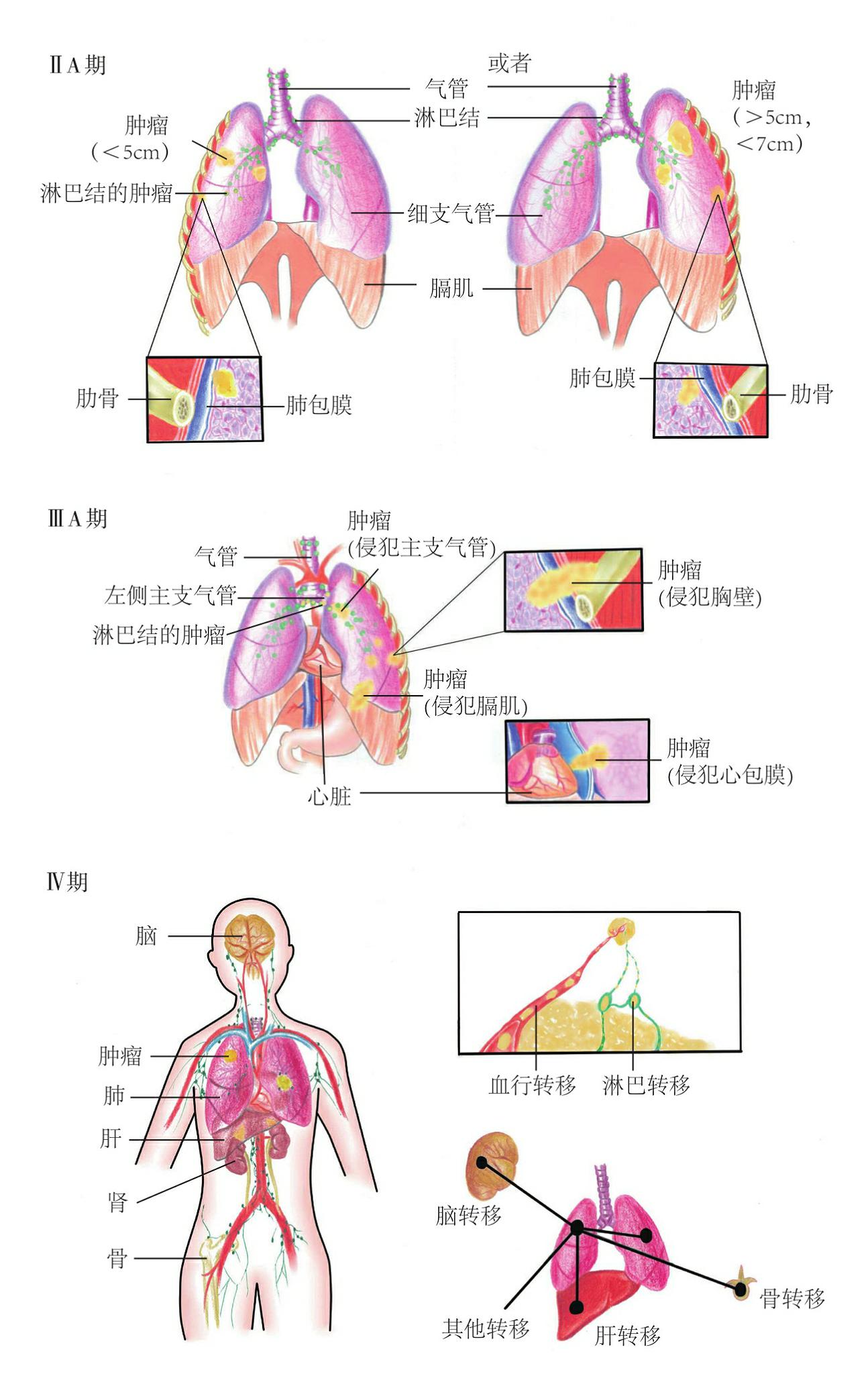 肺癌分期