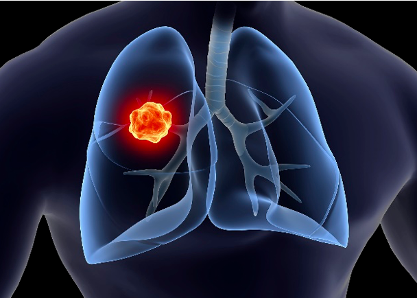 小细胞肺癌生存期