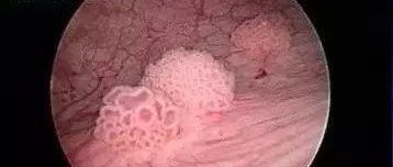 尿道癌群经验,尿道癌需要做什么检查？