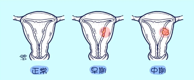 子宫内膜癌的六个信号