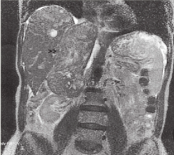 右侧肾上腺静脉平滑肌肉瘤的MRI影像
