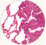 滑膜肉瘤的病理学图像