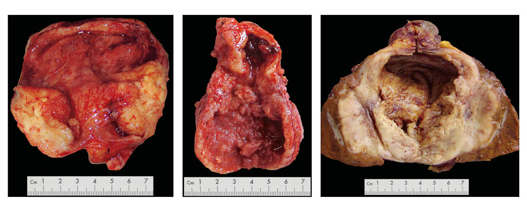 胆囊癌发病机制，左图:巨块型;中图:结节型;右图:浸润型