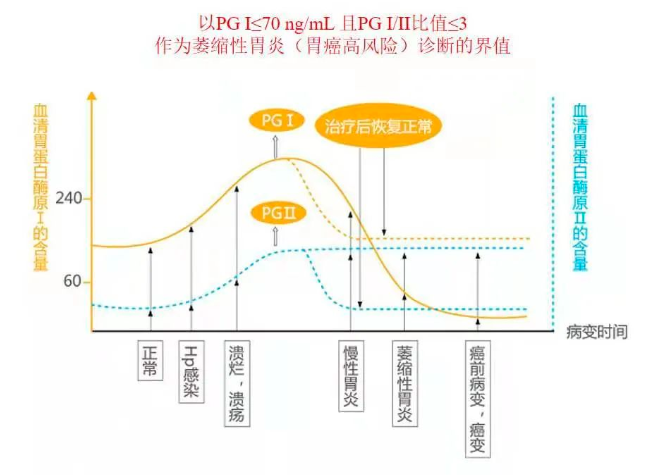 血清胃蛋白酶原与胃部疾病进展