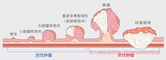 肠息肉会演变肠癌吗