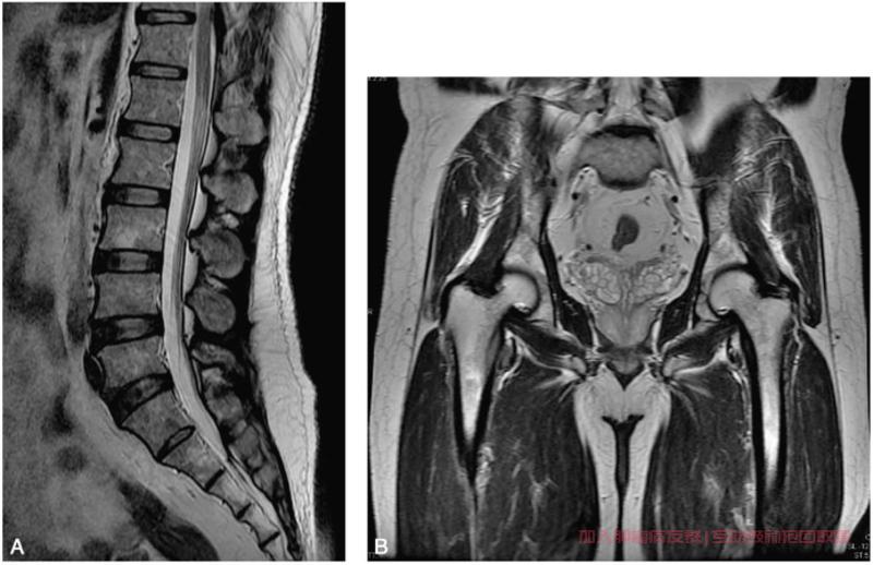 慢性白血病MRI