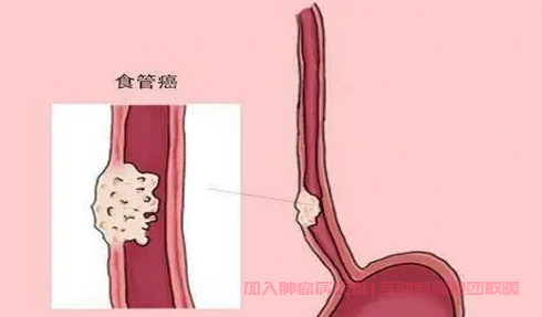 食管堵塞梗阻是食管癌吗