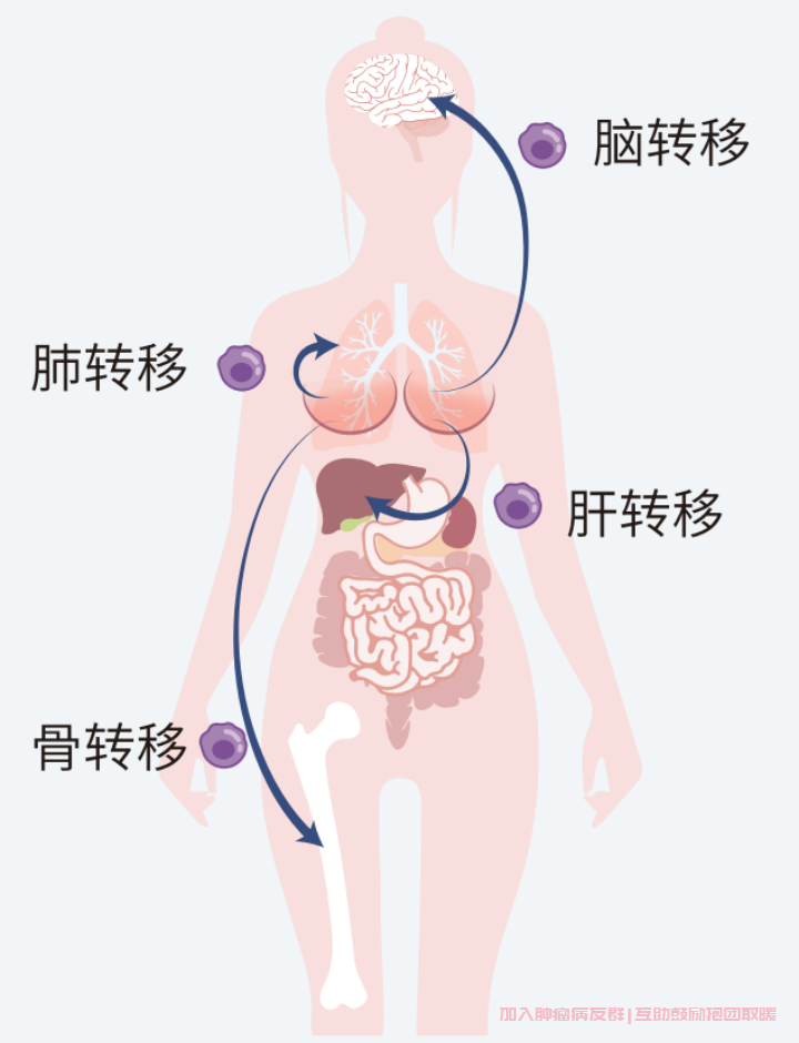 乳腺癌转移